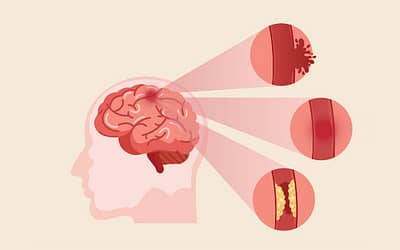 Everything you need to know about brain stroke